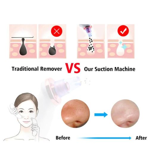 Blackhead Removal Suction Tool - Image 5